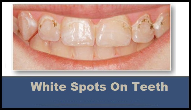 teeth spots treatment causes